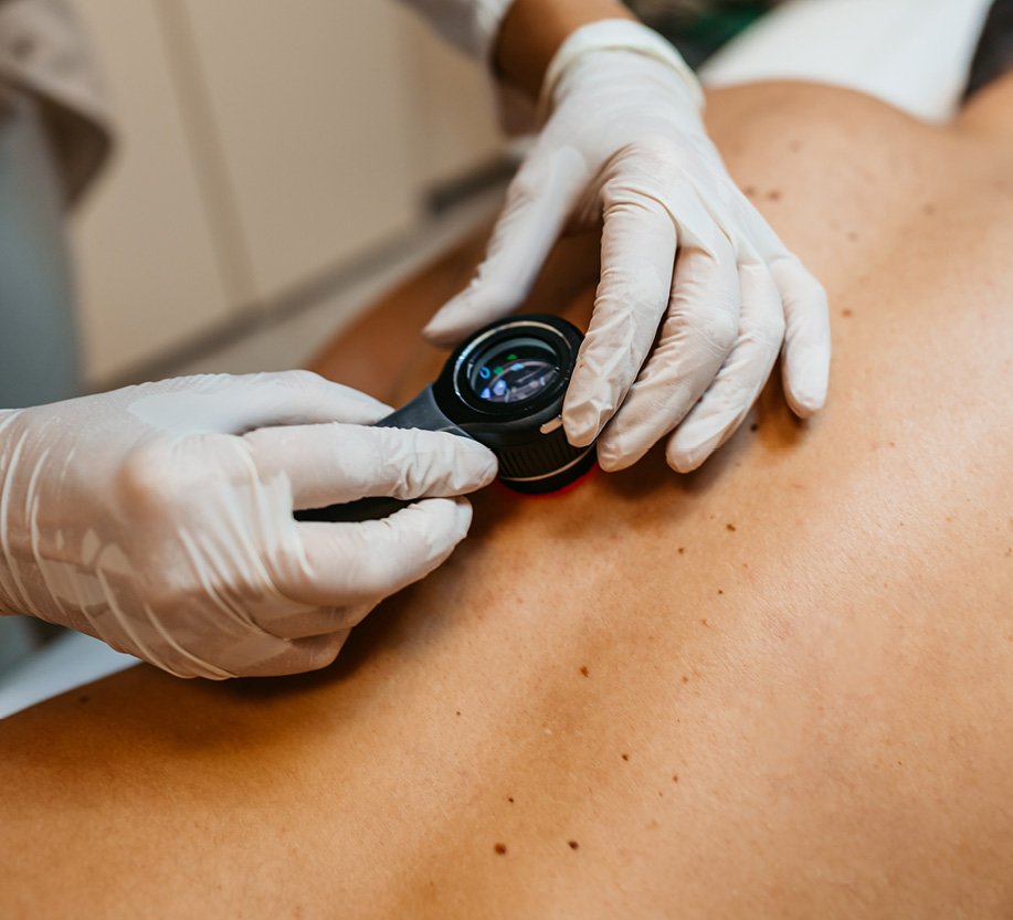 doctor looking at back with raised moles