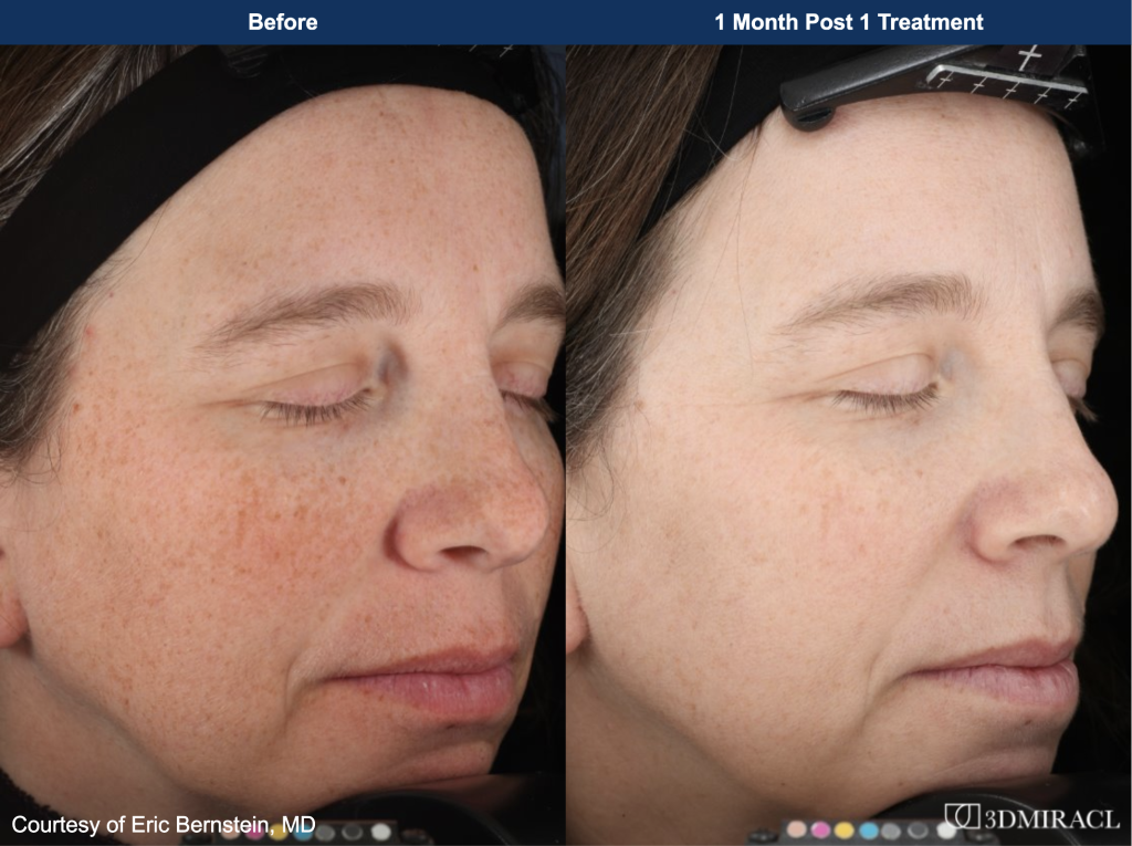 before & after of someone's skin using UltraClear Laser Skin rejuvenation