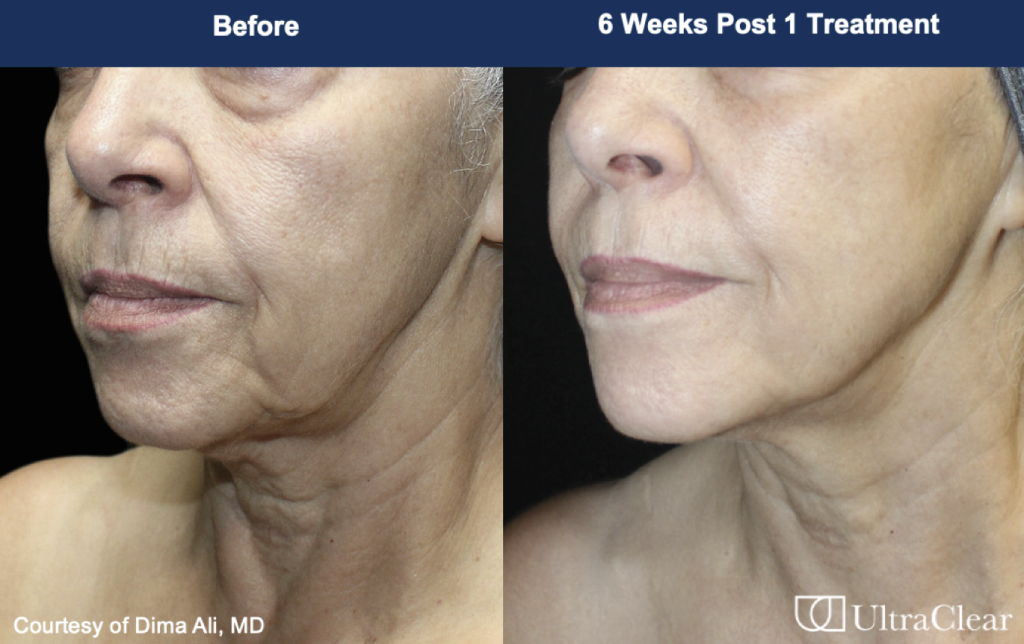 before & after of someone's skin using UltraClear Laser Skin rejuvenation